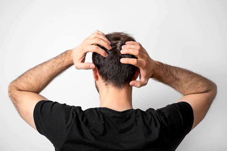 How To Treat A Dry Scalp?