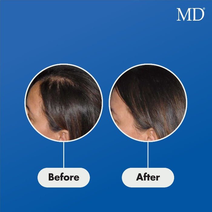 MD® Follicle Energizer Serum - Natural Hair Growth Serum - 30-Day Supply - MD