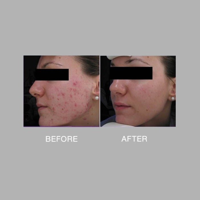 acne control using cream
