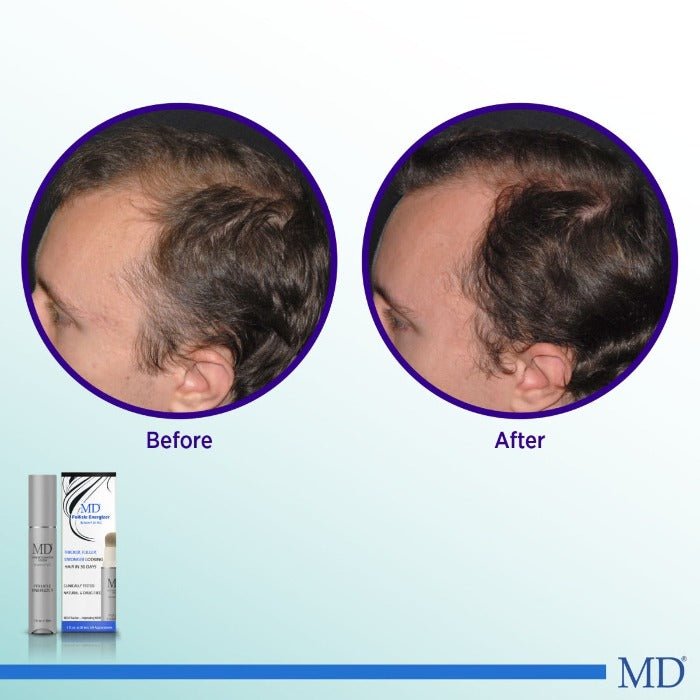 MD HAIR RESTORATION STARTER KIT - MDHair 