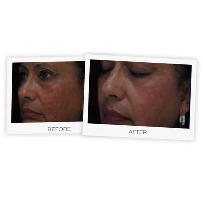 এমডি ব্রাইটনিং ক্রিম ব্যবহারের আগে এবং পরে মেলাসমা, ডার্ক সার্কেল কমে যাওয়া এবং ত্বকের উজ্জ্বলতা বৃদ্ধি পাওয়া।