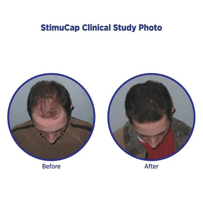 MD Hair-এর MD Revitalizing Conditioner ব্যবহার করে পুরুষ পরীক্ষার্থীর ছবি। StimuCap® - নিয়মিত ব্যবহারের পরে মাথার ত্বকের আবরণের দৃশ্যমান পুনরুদ্ধার এবং চুলের ঘনত্ব বৃদ্ধি দেখায়।