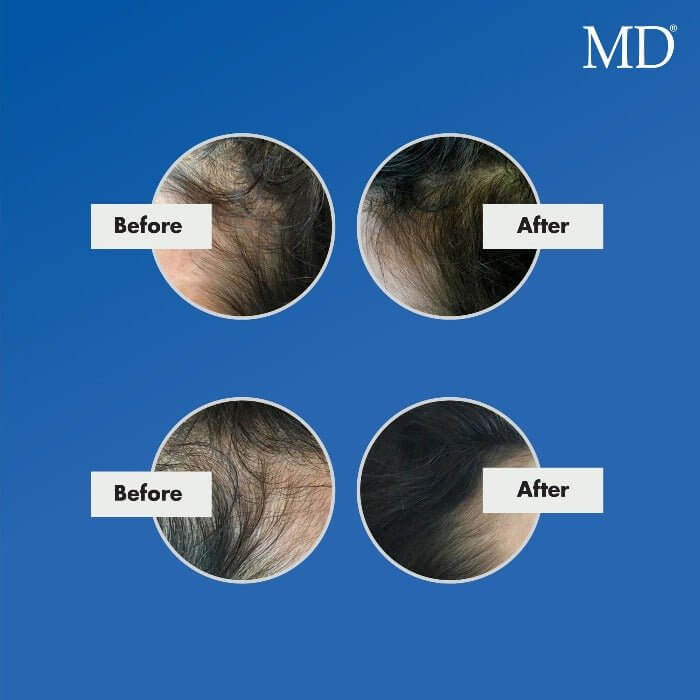 Before and after photo of woman with receding hairline showing new hair growth and visibly filled-in temples after using MD Nutri Hair – drug-free hair growth supplement from MD Hair