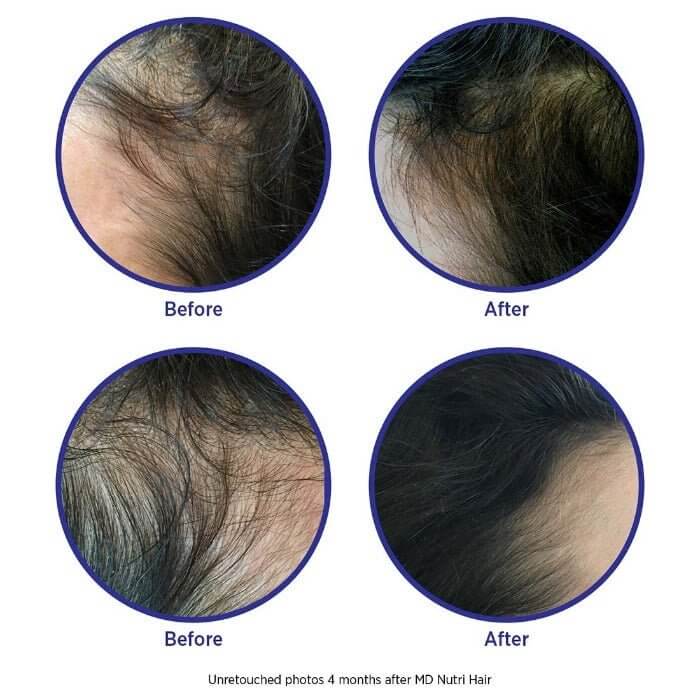4-month before and after using MD Nutri Hair – visible hairline regrowth on both sides, fuller, thicker hair appearance