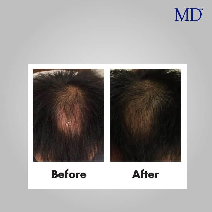 Before and after results showing visible improvement in bald spot with consistent use of MD Scalp Essential from the MD Hair collection

