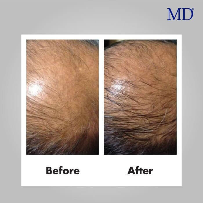 Before and after photo showing reduced oily scalp and visible fine hair growth after using MD Scalp Essential from the MD Hair collection

