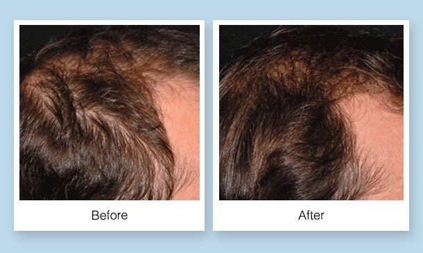 MD Hair Follicle Energizer for baldness