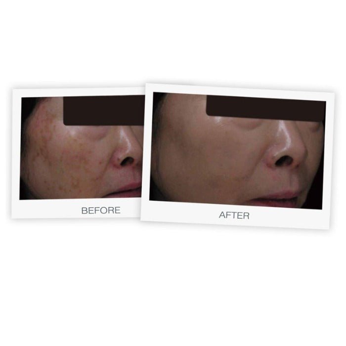 MD Brightening Cream before after effects